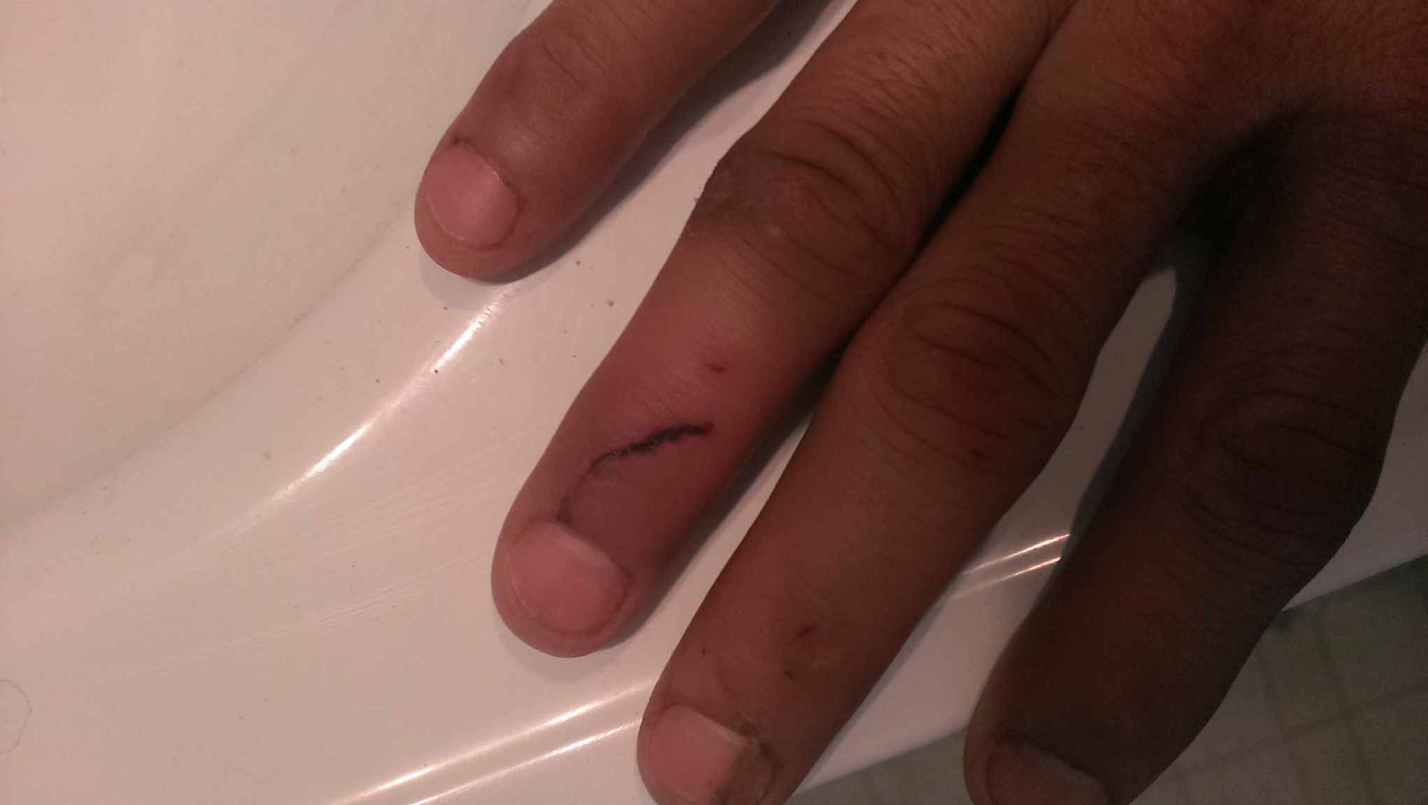 Dominic Bara_3(Contributed Photo Diego Bara) Dominic Bara's injuries. (Contributed/ Diego Bara)