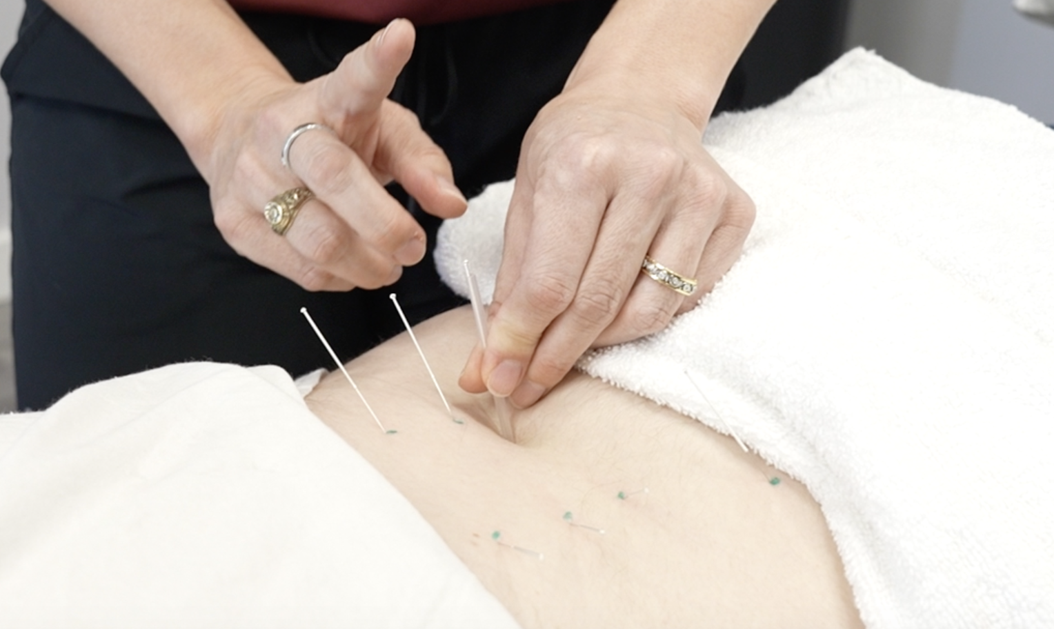 Dry Needling at Movement Therapy