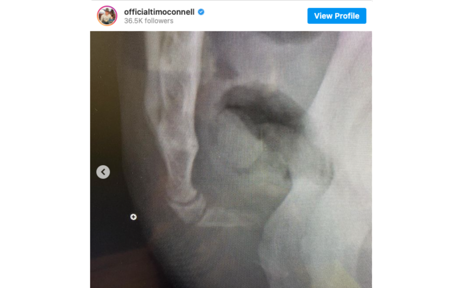 Tim O'Connell Broken Tailbone