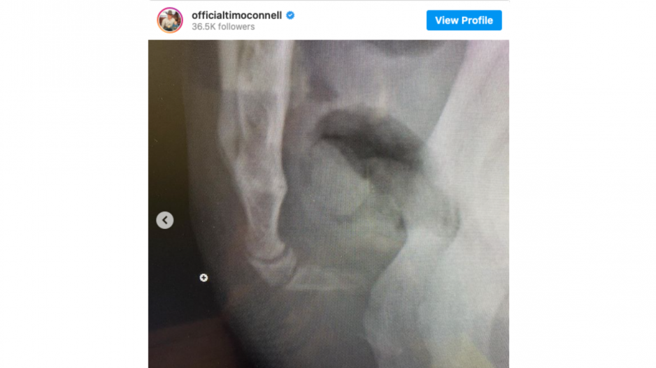 Tim O'Connell Broken Tailbone Tim O'Connell Broken Tailbone