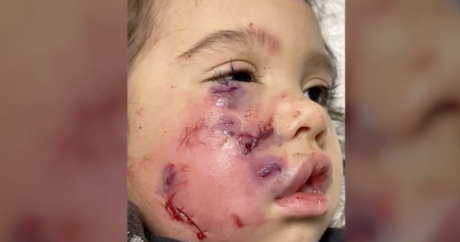 Child Bitten by a Pitbull in Harris County