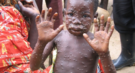 Child Infected with Monkeypox Virus (Contribute/nationalgeographic)