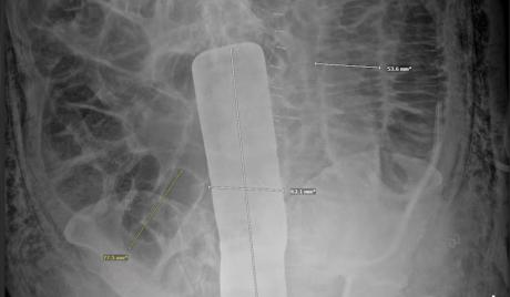 X-Ray of the Surgical Tool sealed inside Genaro Nava