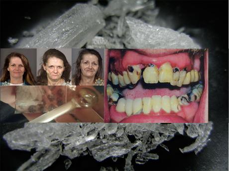 Side effects of meth use include rotting teeth, gaunt postures, aging and weight loss. (Photo courtesy of Google)