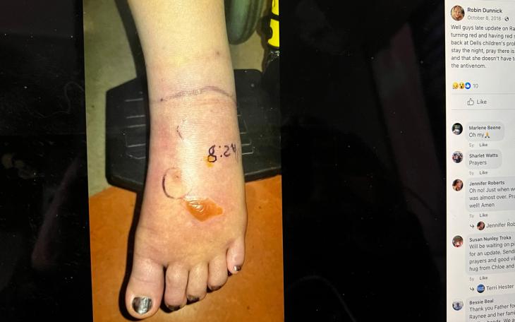 In this Oct 8, 2018 Facebook post, mom Robin Dunnick told her Facebook friends, &quot;Well guys late update on Ray, her foot started turning red and having red spots so we are back at Dells children's probably gonna have to stay the night, pray there is no fang fragments and that she doesn't have to start all over with the antivenom.&quot;
