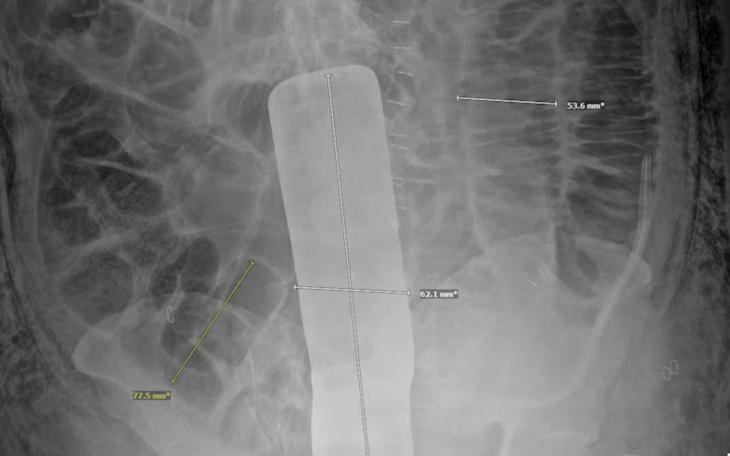 X-Ray of the Surgical Tool sealed inside Genaro Nava